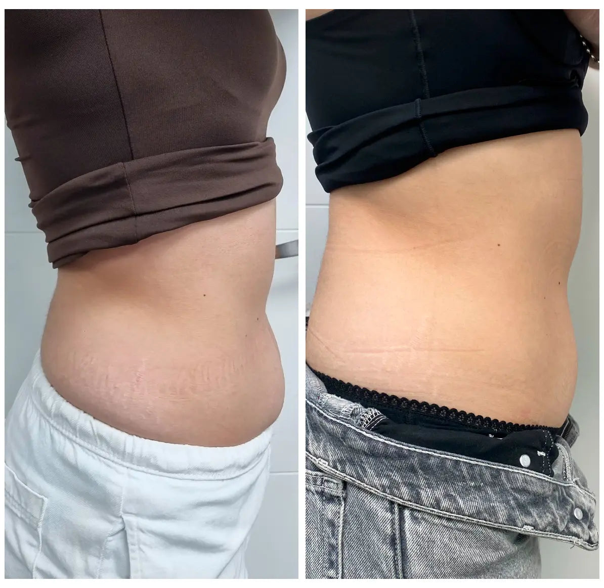 Antes y después de abdomen, vista lateral